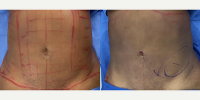 Case 8916 - Woman treated with Liposuction