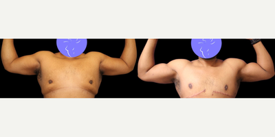 Case 8917 - Woman treated with Vaser Liposuction, Liposuction, Arm Lift