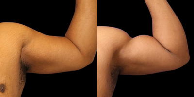 Case 8918 - Woman treated with Vaser Liposuction, Liposuction, Arm Lift