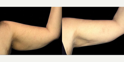 Case 8920 - Woman treated with Liposuction, Skin Tightening