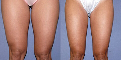 Case 8922 - Woman treated with Liposuction