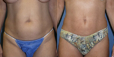 Case 8923 - Woman treated with Liposuction