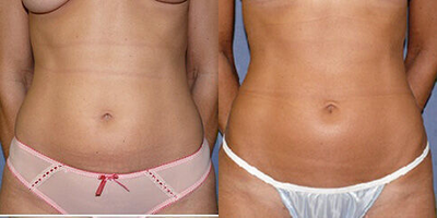 Case 8924 - Woman treated with Liposuction