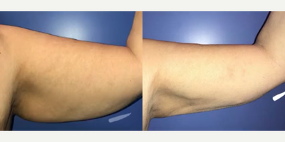 Case 8926 - Woman treated with Liposuction