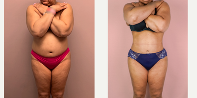 Case 8929 - 55-64 year old woman treated with Liposuction, Brazilian Butt Lift