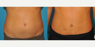 Case 8937 - Woman treated with Liposuction