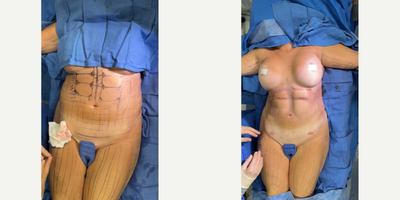 Case 8938 - 55-64 year old woman treated with Liposuction, Vaser Liposuction