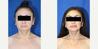 Case 8939 - 35-44 year old woman treated with Liposuction