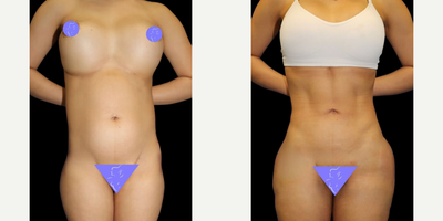 Case 8942 - 35-44 year old woman treated with Liposuction, Brazilian Butt Lift