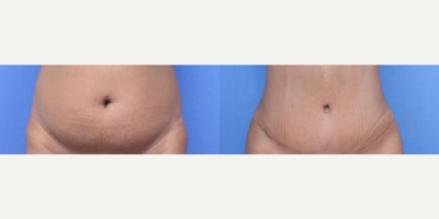 Case 8943 - Woman treated with Liposuction