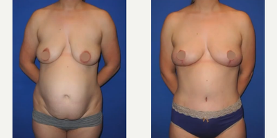 Case 8944 - Woman treated with Tummy Tuck, Liposuction