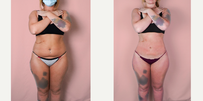 Case 8945 - 18-24 year old woman treated with Liposuction