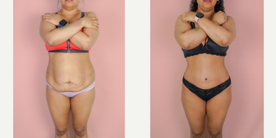 Case 8946 - 25-34 year old woman treated with Tummy Tuck, Liposuction