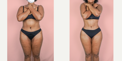 Case 8947 - 25-34 year old woman treated with Liposuction, Brazilian Butt Lift