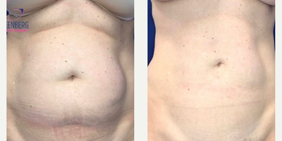 Case 8948 - Woman treated with Liposuction