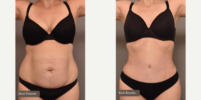 Case 8949 - Woman treated with Tummy Tuck, Liposuction