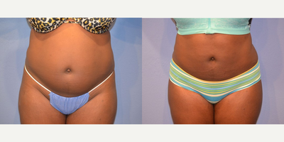 Case 8952 - Woman treated with Liposuction