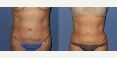 Case 8953 - 53 year old woman treated with Liposuction