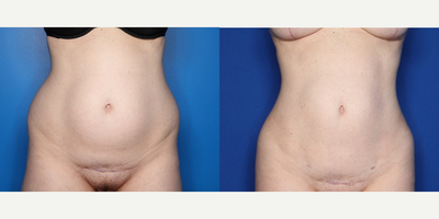 Case 8954 - 39 year old woman treated with Liposuction