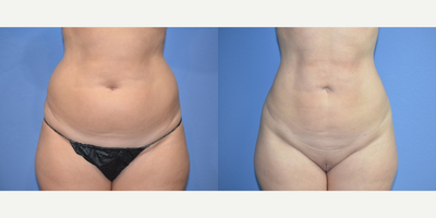 Case 8955 - 43 year old woman treated with Liposuction