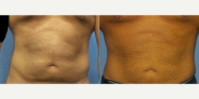 Case 8956 - Man treated with Liposuction