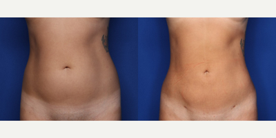 Case 8957 - 25 year old woman treated with Liposuction
