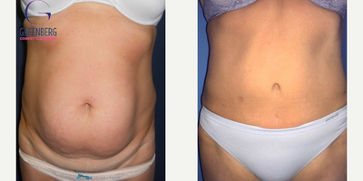 Case 8960 - Woman treated with Tummy Tuck, Liposuction