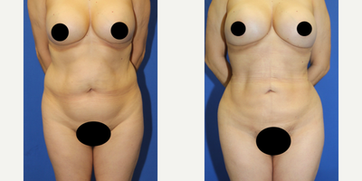 Case 8961 - 35-44 year old woman treated with Liposuction