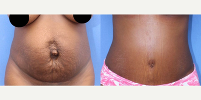 Case 8963 - Woman treated with Liposuction