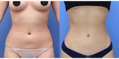 Case 8964 - Woman treated with Liposuction