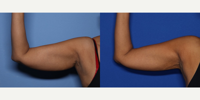 Case 8969 - 51 year old woman treated with Liposuction, Arm Lift