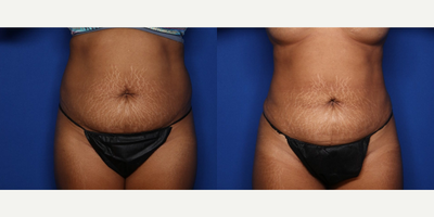 Case 8970 - 39 year old woman treated with Liposuction, Morpheus8, Microneedling