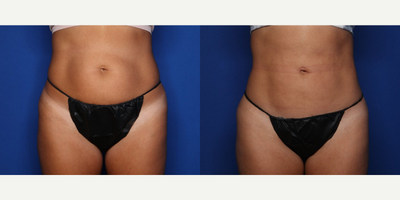 Case 8971 - 37 year old woman treated with Liposuction