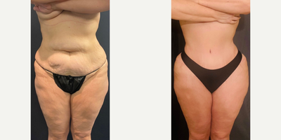 Case 8972 - Woman treated with Liposuction
