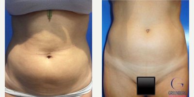 Case 8974 - Woman treated with Liposuction