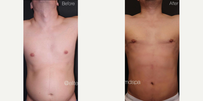 Case 8975 - Man treated with Liposuction