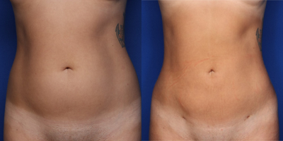 Case 8976 - 25-34 year old woman treated with Liposuction, Brazilian Butt Lift
