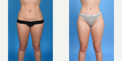 Case 8981 - 25 year old woman treated with Liposuction