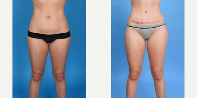 Case 8982 - 25 year old woman treated with Liposuction