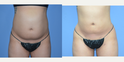 Case 8983 - 25-34 year old woman treated with Liposuction