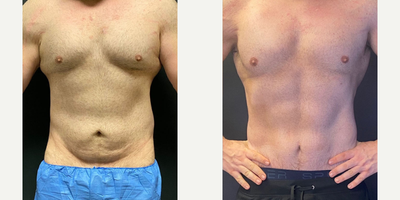 Case 8984 - Man treated with Liposuction