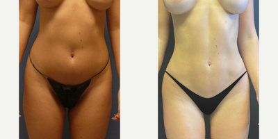 Case 8986 - Woman treated with Liposuction