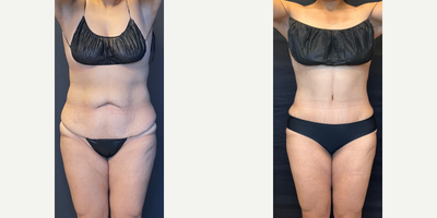 Case 8987 - Woman treated with Liposuction