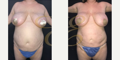 Case 8988 - Woman treated with Liposuction