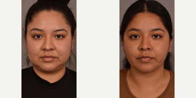 Case: 8989 - before and after photo of Woman treated with Chin Liposuction by Thomas P. Sterry, MD