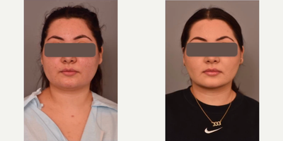 Case: 8990 - before and after photo of Woman treated with Chin Liposuction by Thomas P. Sterry, MD