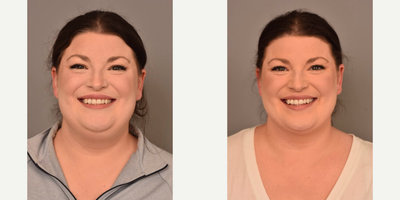 Case: 8991 - before and after photo of Woman treated with Chin Liposuction by Thomas P. Sterry, MD