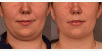 Case: 8992 - before and after photo of Woman treated with Chin Liposuction by Thomas P. Sterry, MD