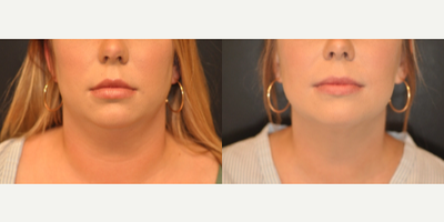Case: 8993 - before and after photo of 25-34 year old woman treated with Chin Liposuction by Robert L. Steely, MD, FACS