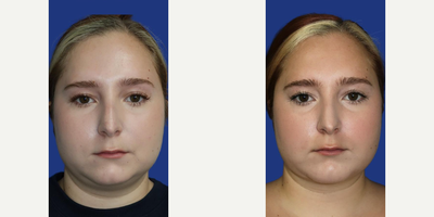Case: 8994 - before and after photo of Woman treated with Chin Implant, Chin Liposuction by Raymond E. Lee, MD